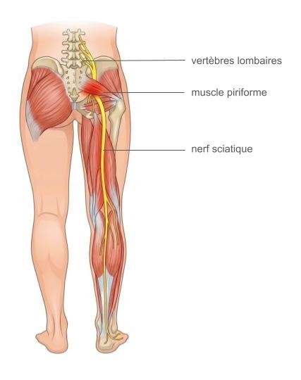 Soulager la sciatique par la chiropraxie - chiropracteur à Angers